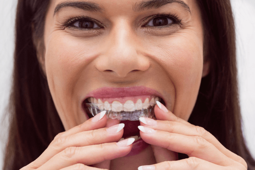 The ‘Commitment Problem’: Why Some Patients Quit Clear Aligners Mid-Treatment (And What Actually Works)