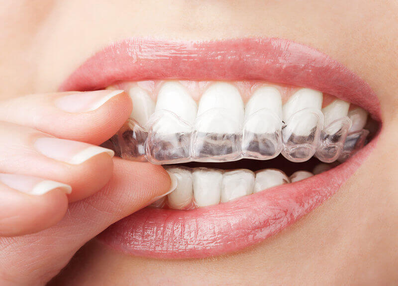 The Everyday Benefits That Make Invisalign So Popular