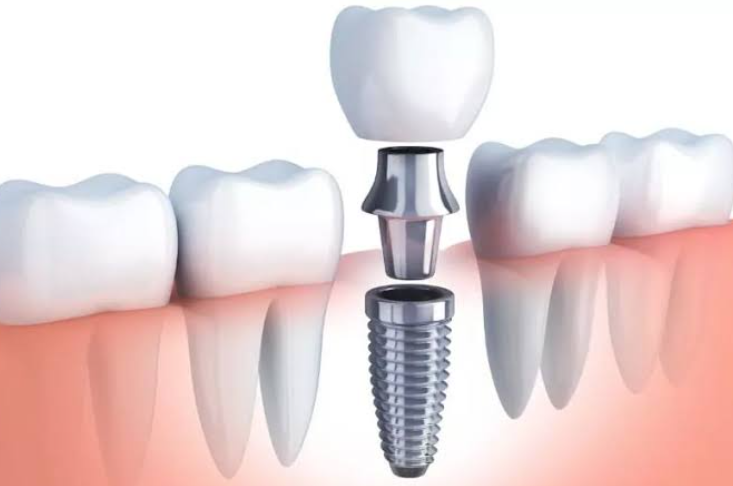 4 Ways Technology Improves The Look Of Dental Implant Restorations