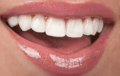 5 Smile Makeover Procedures Commonly Offered In Family Dental Practices