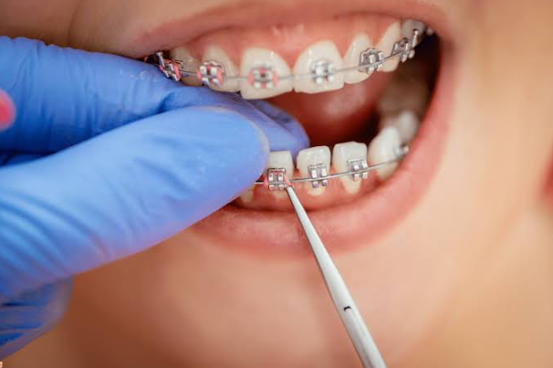 5 Reasons Regular Adjustments Are Key To Orthodontic Success